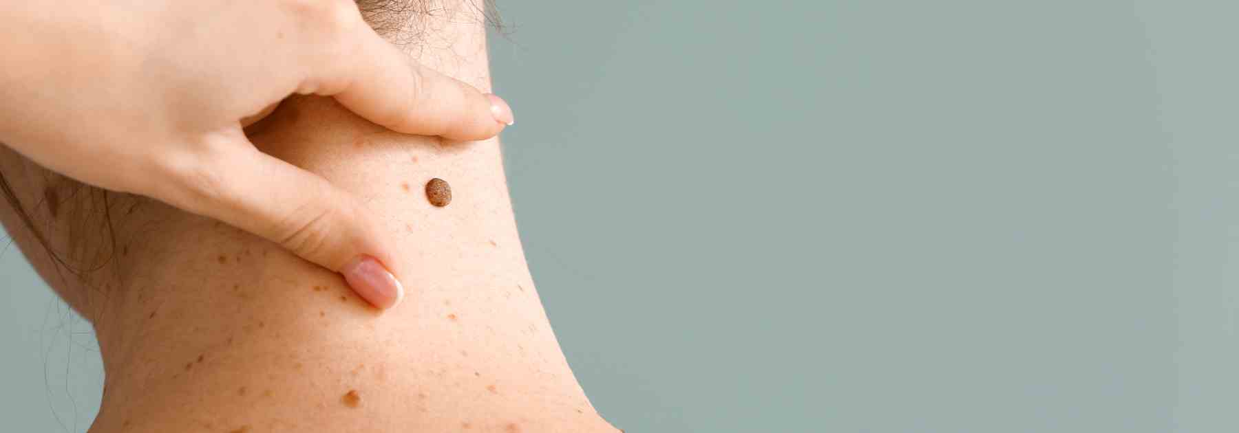 Mole scanning in Glenrothes to protect your skin