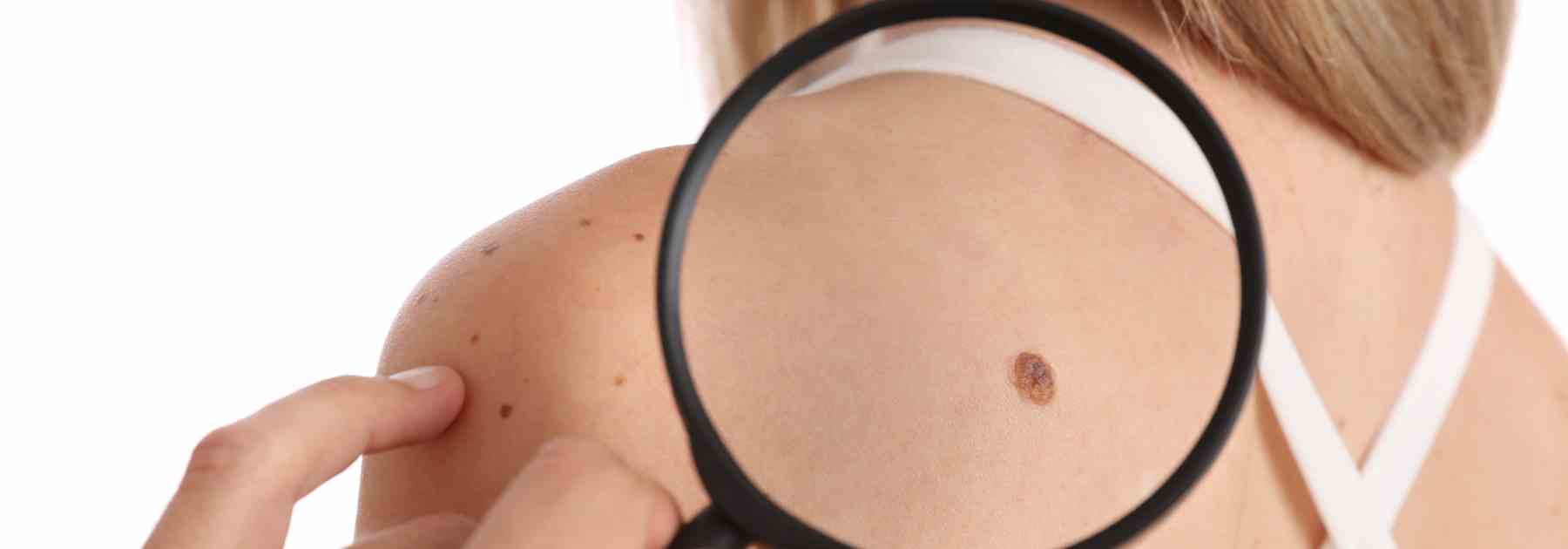 Remove warts with cryotherapy in Glenrothes